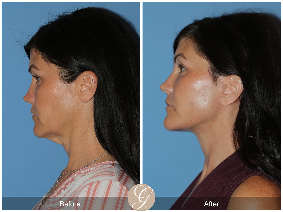 Lower Facelift Before & After Photo