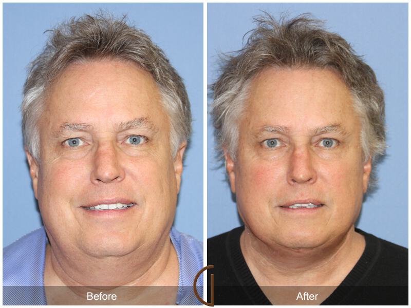 Neck Lift Before & After Photo