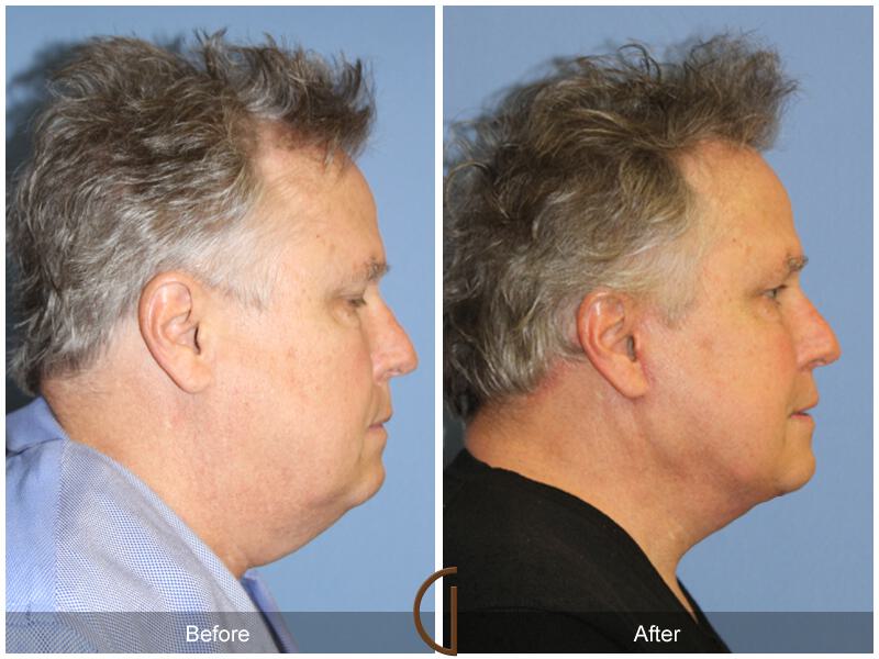 Neck Lift Before & After Photo