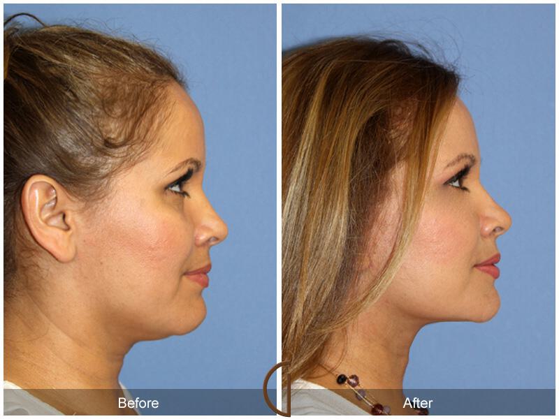 Neck Lift Before & After Photo