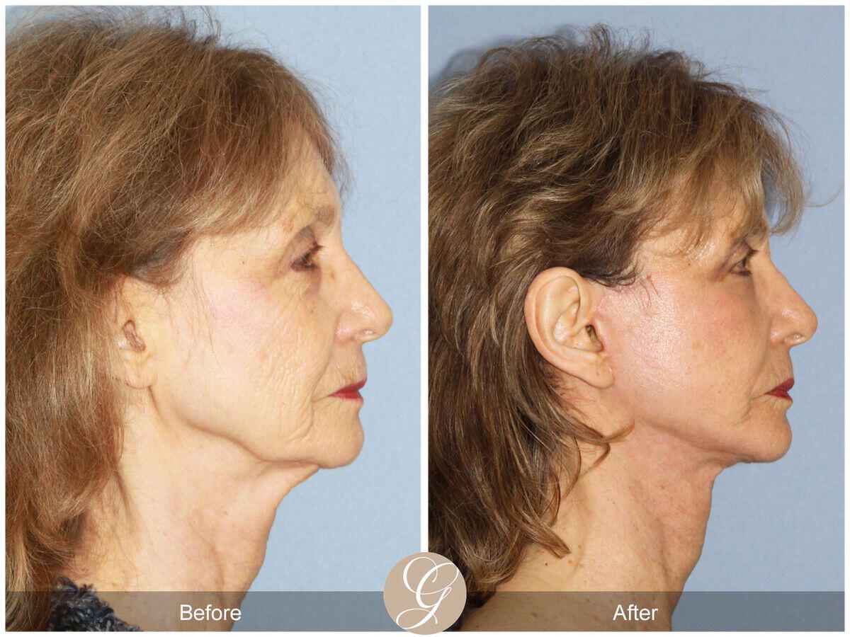 Neck Lift Before & After Photo