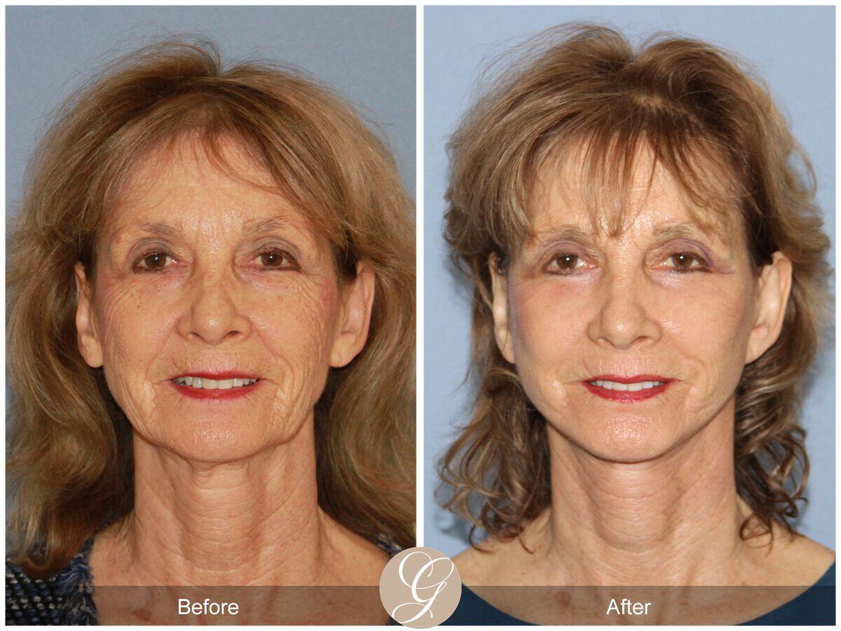 Neck Lift Before & After Photo