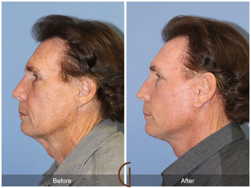 Neck Lift Before & After Photo