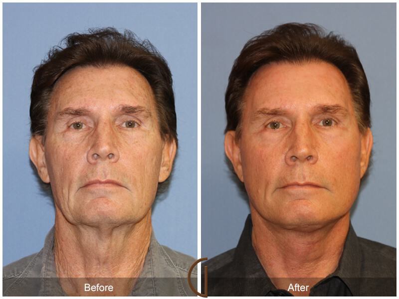 Neck Lift Before & After Photo