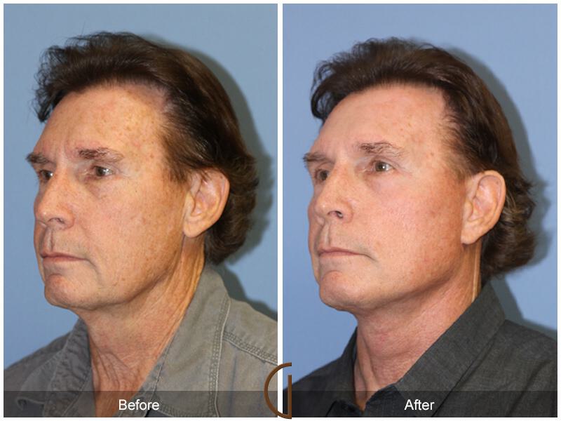 Neck Lift Before & After Photo