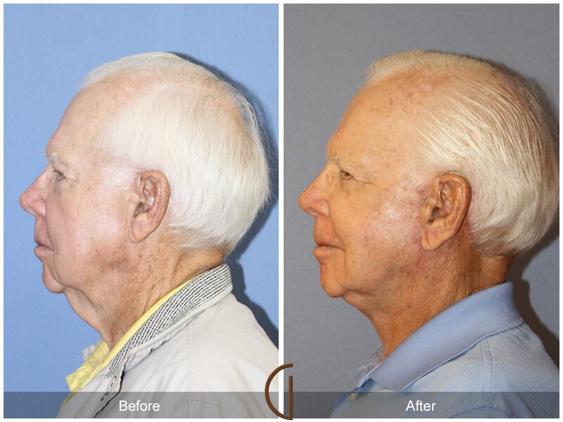 Neck Lift Before & After Photo