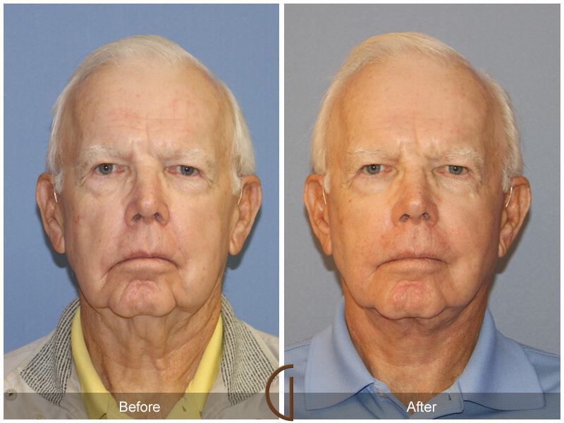 Neck Lift Before & After Photo