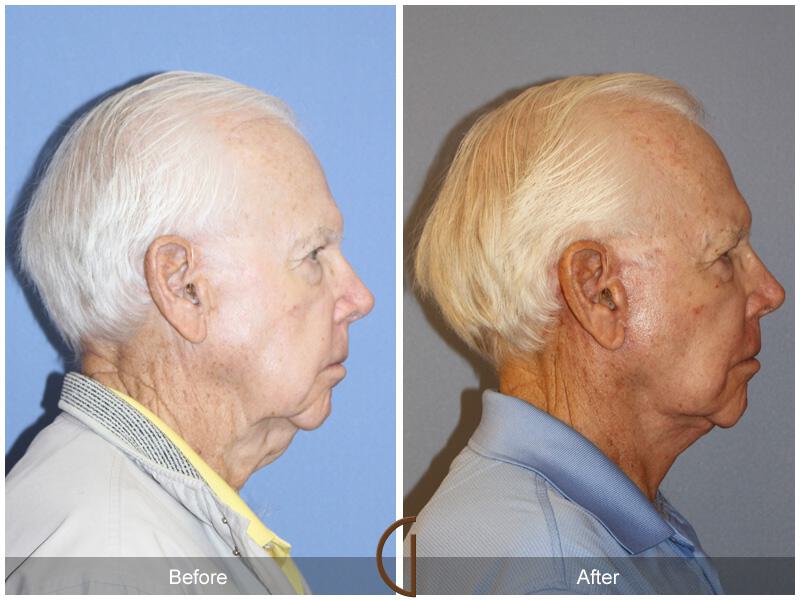 Neck Lift Before & After Photo