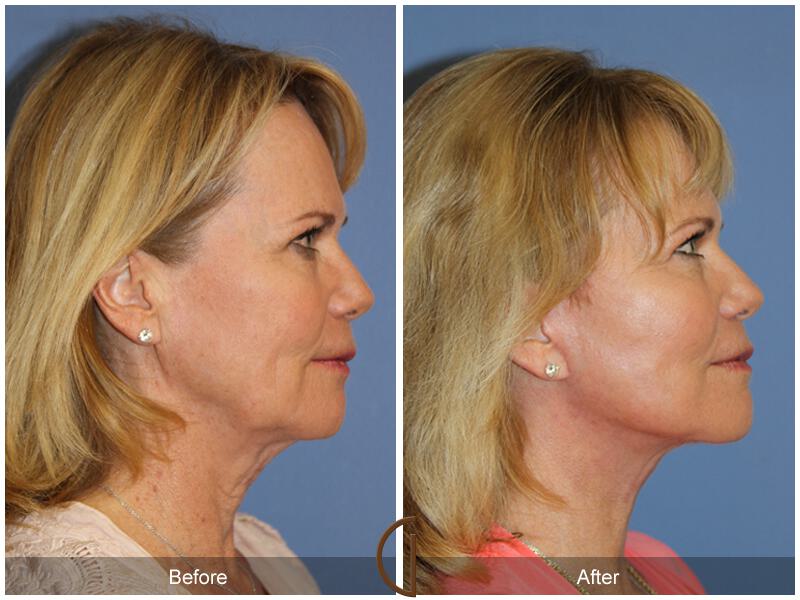 Neck Lift Before & After Photo