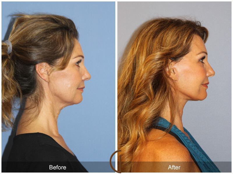 Neck Lift Before & After Photo