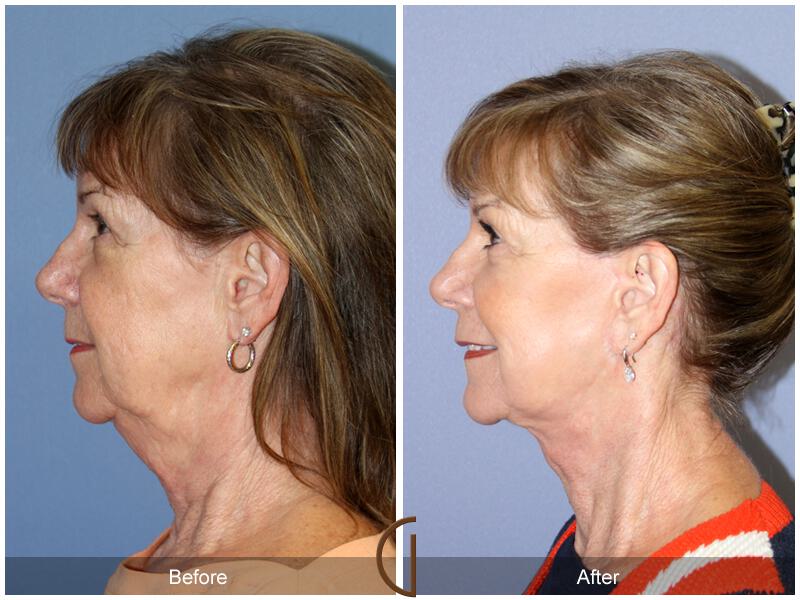 Neck Lift Before & After Photo