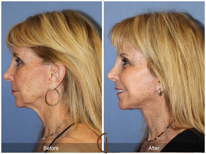 Neck Lift Before & After Photo