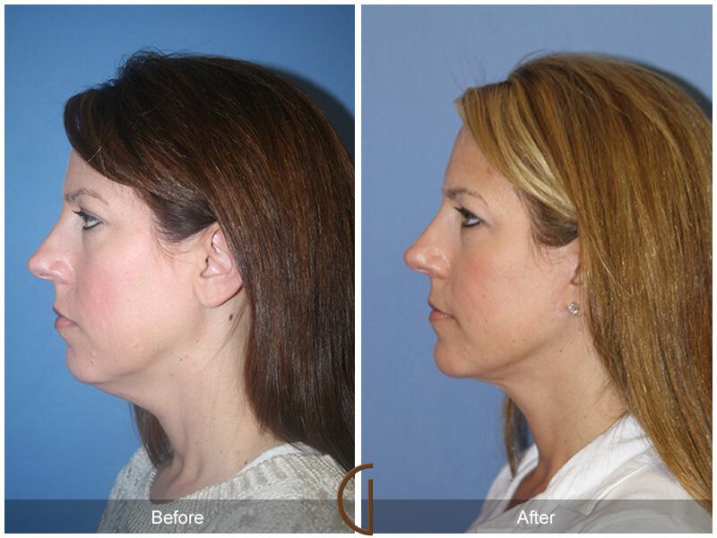 Neck Lift Before & After Photo