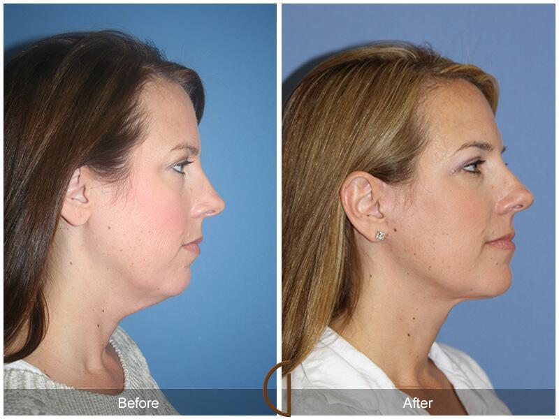 Neck Lift Before & After Photo