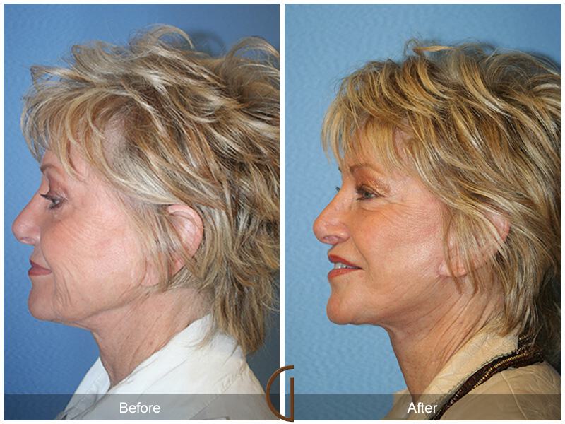 Facelift Revision Before & After Photo