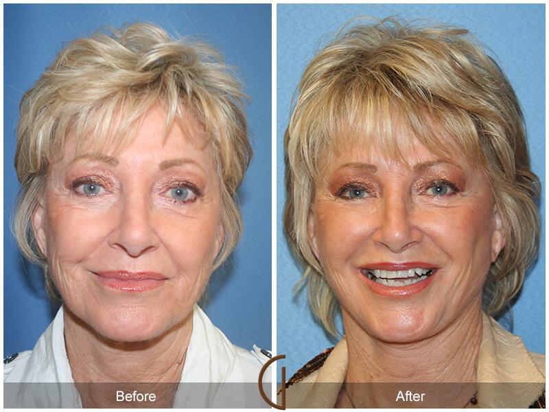 Facelift Revision Before & After Photo