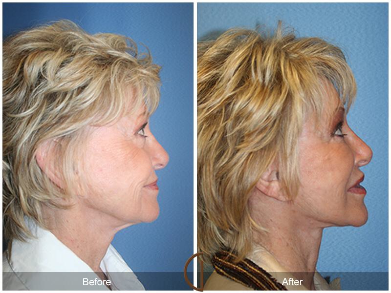 Facelift Revision Before & After Photo