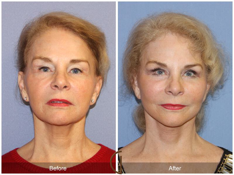Woman Before and After Photo Facelift Newport Beach