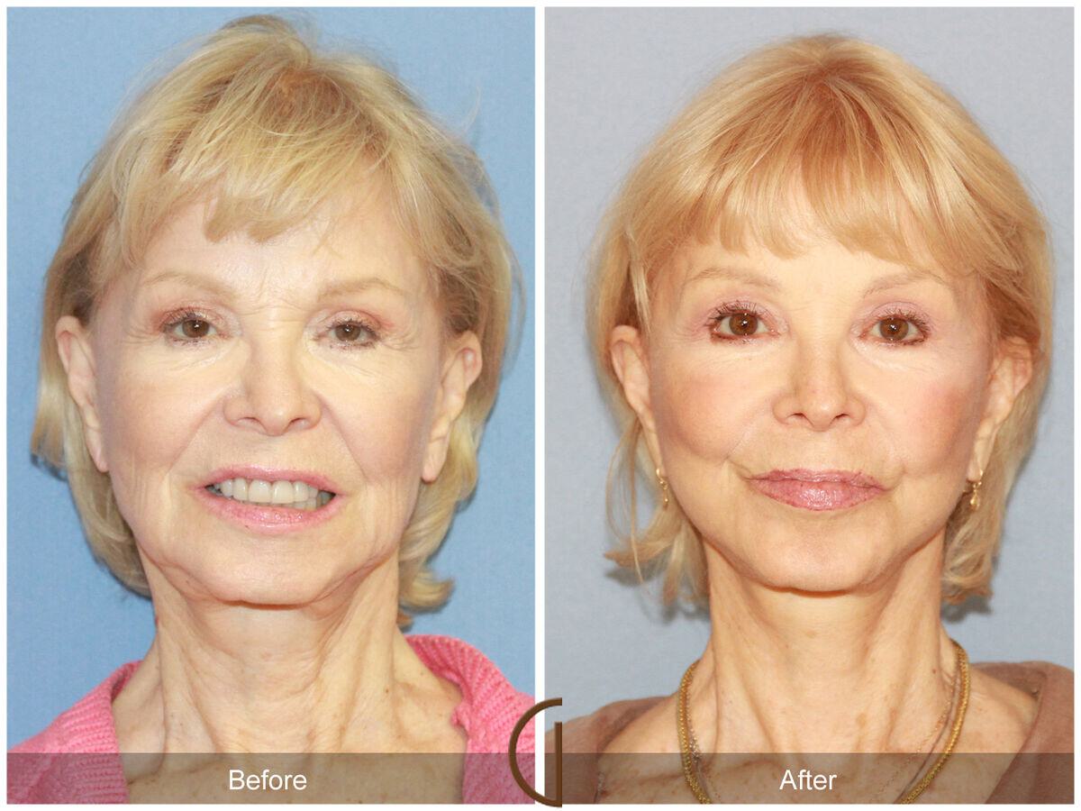 Facelift Revision Before & After Photo