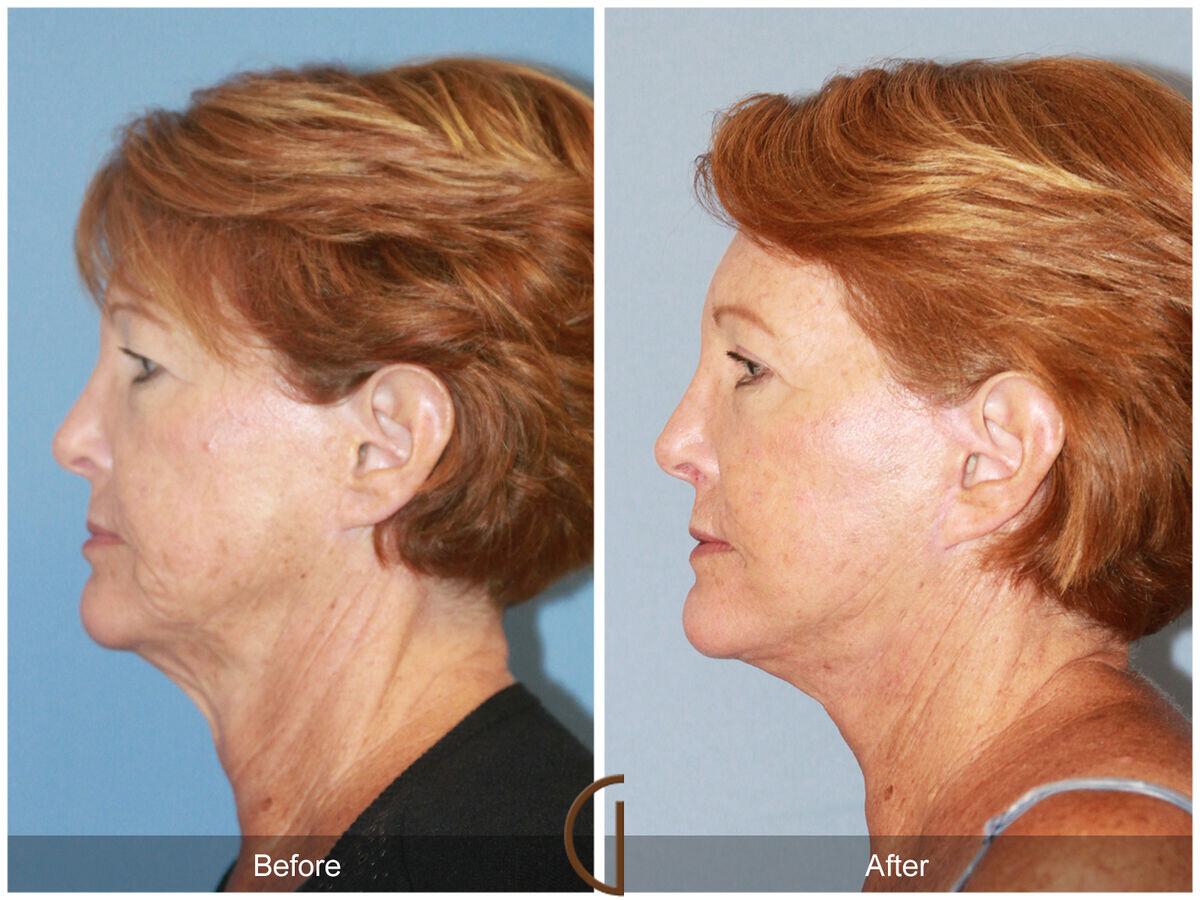 Facelift Revision Before & After Photo