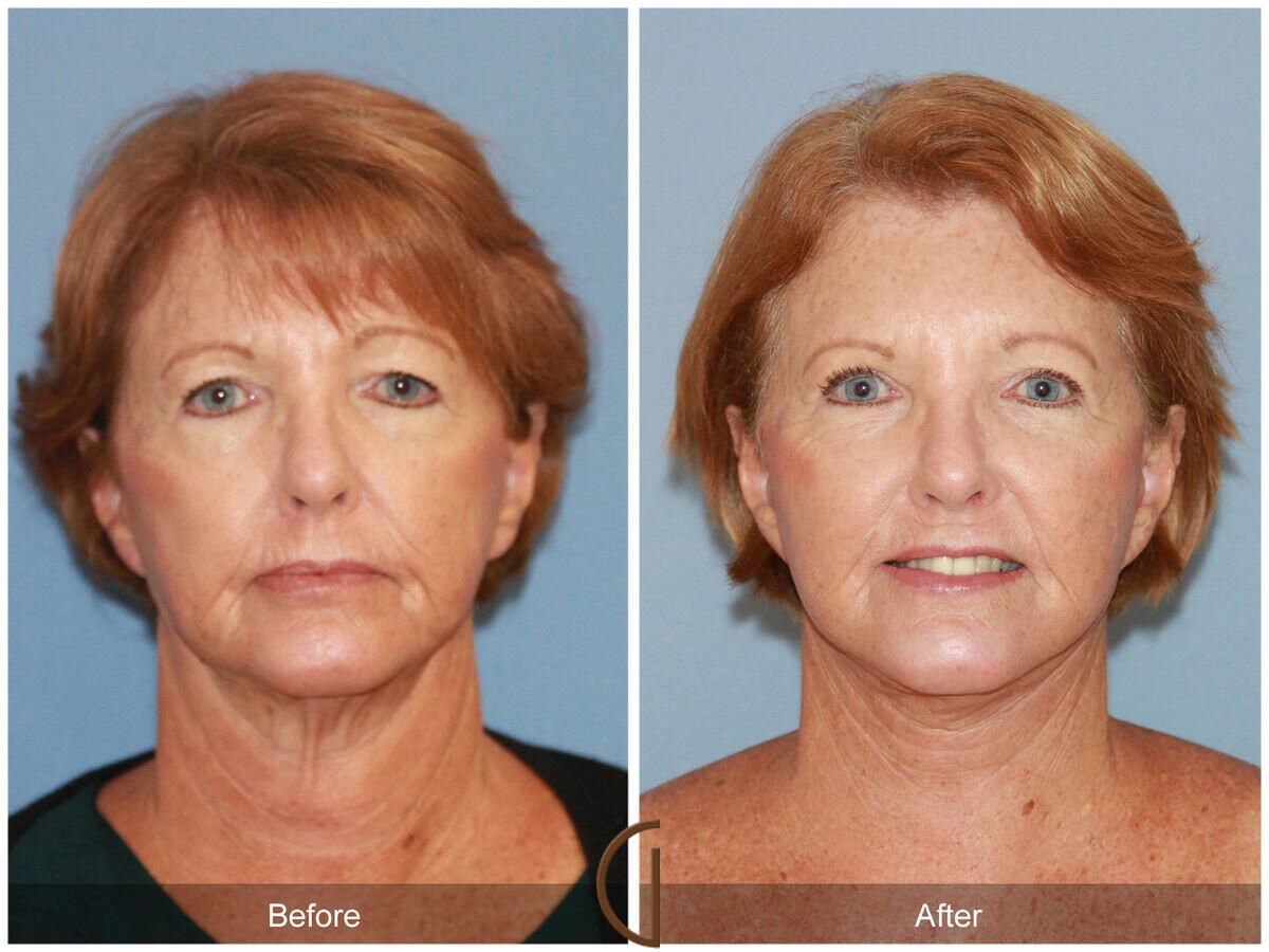 Facelift Revision Before & After Photo