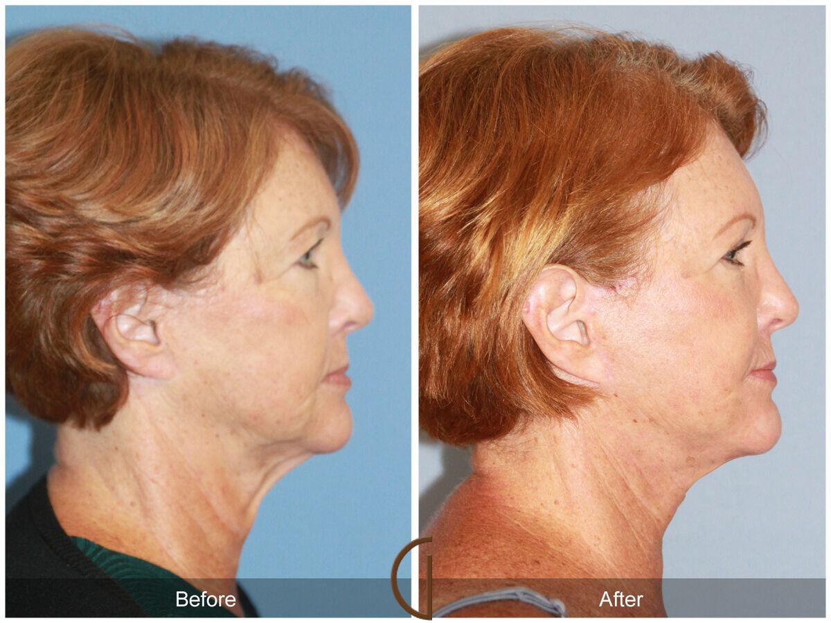 Facelift Revision Before & After Photo