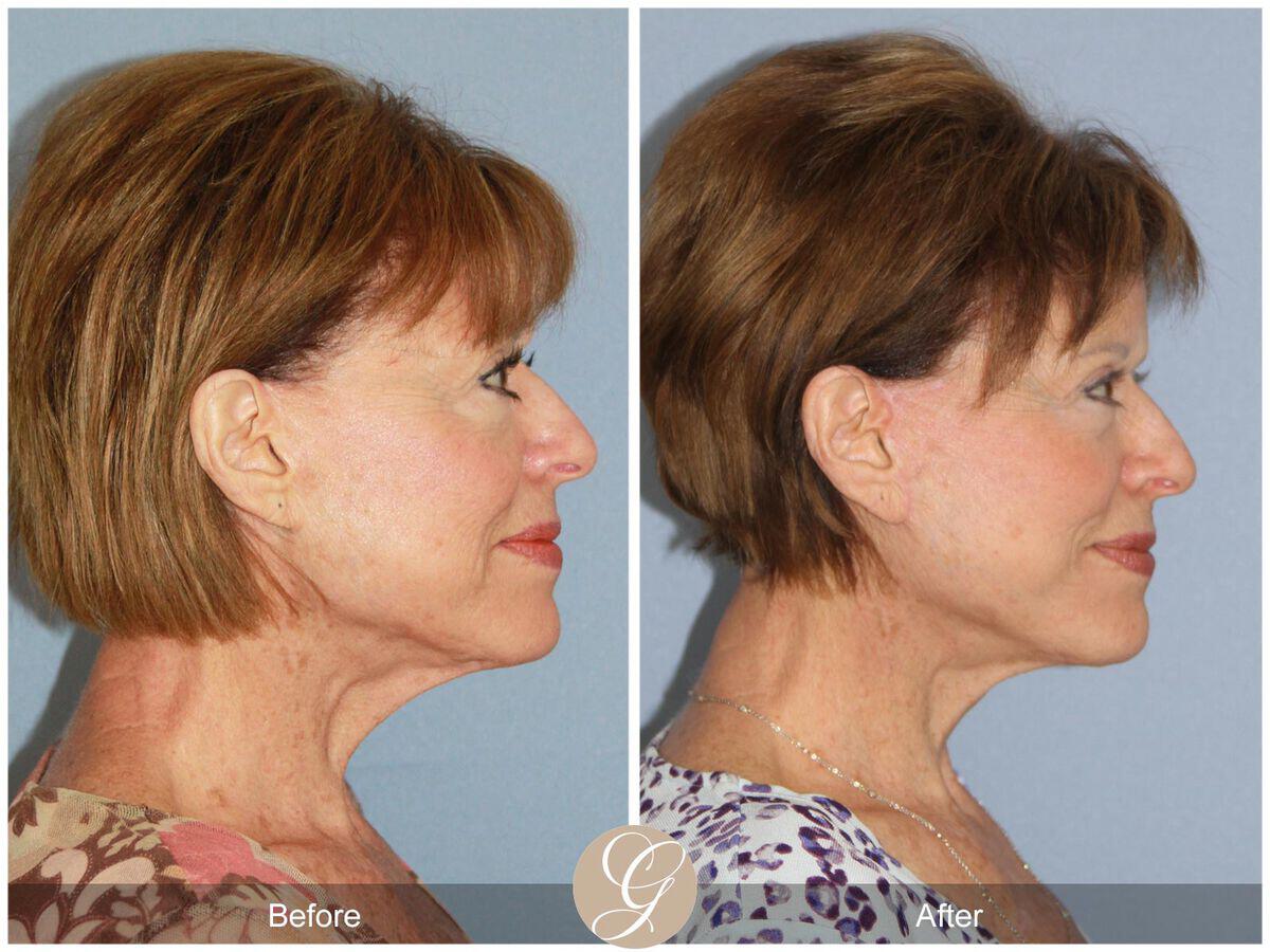 Facelift Revision Before & After Photo