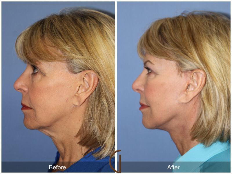 Facelift Revision Before & After Photo