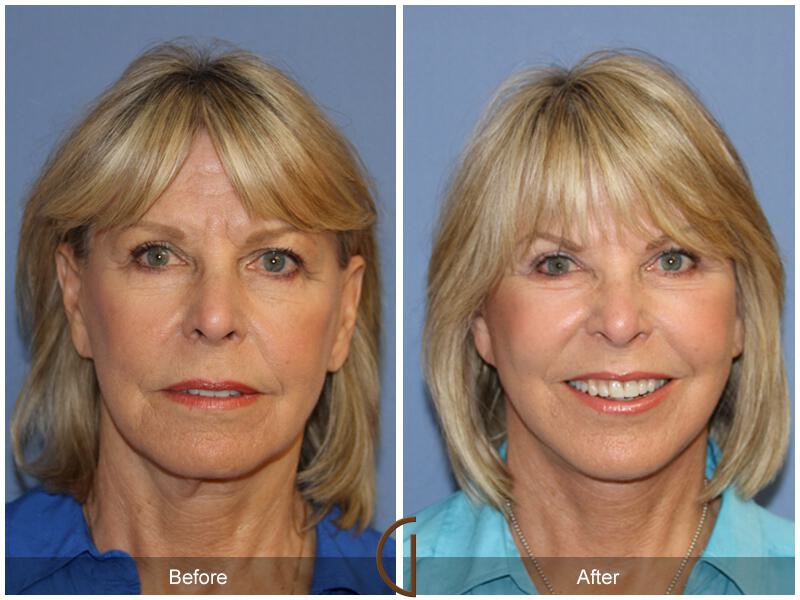 Facelift Revision Before & After Photo