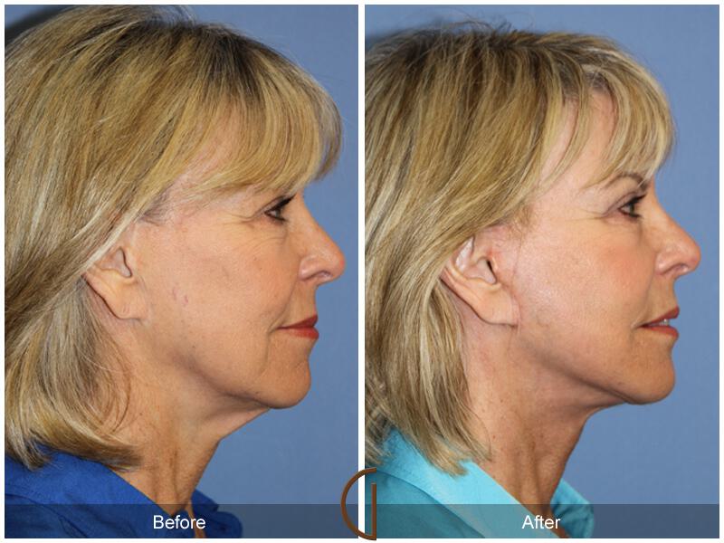 Facelift Revision Before & After Photo