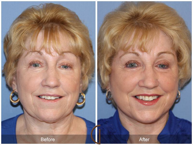 Facelift Revision Before & After Photo