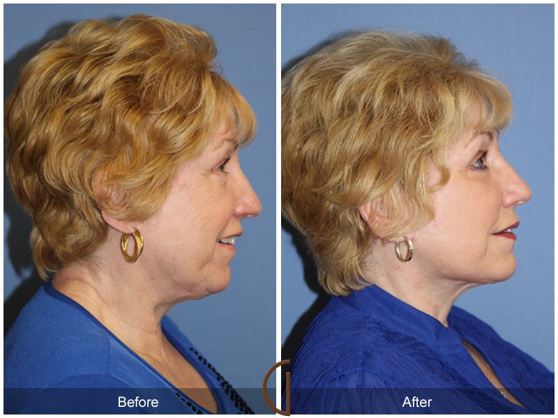 Facelift Revision Before & After Photo