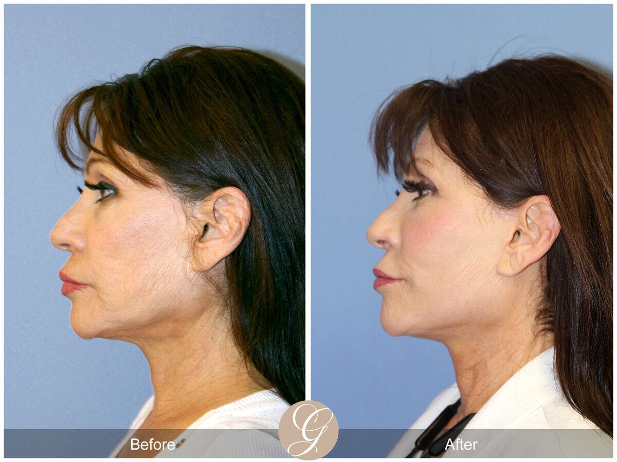 Facelift Revision Before & After Photo