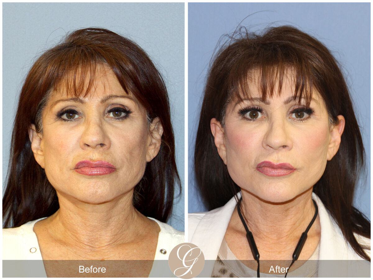 Facelift Revision Before & After Photo