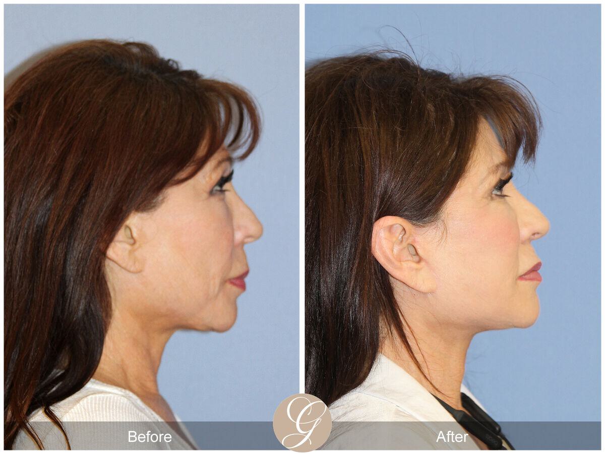 Facelift Revision Before & After Photo