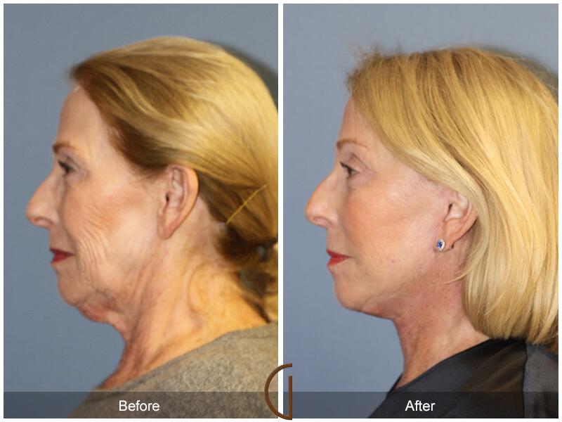 Facelift Revision Before & After Photo