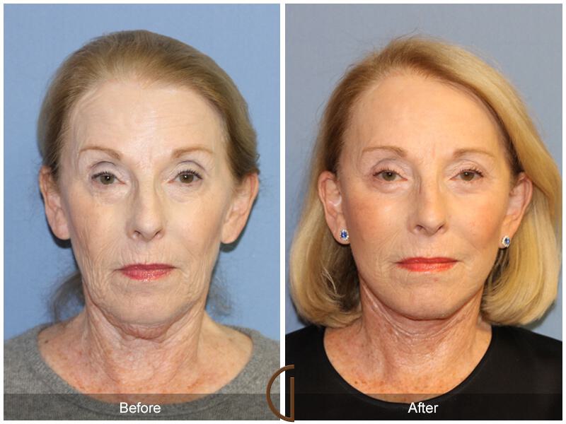 Facelift Revision Before & After Photo