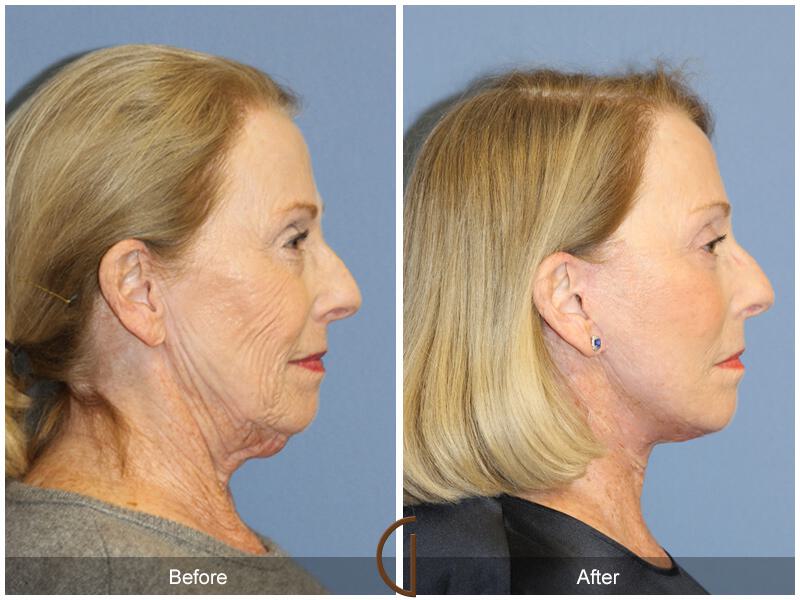 Facelift Revision Before & After Photo