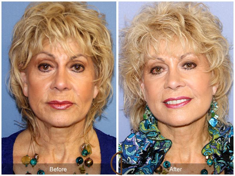 Facelift Revision Before & After Photo