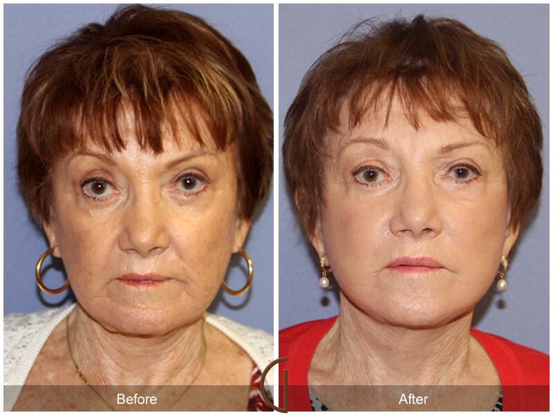 Facelift Revision Before & After Photo