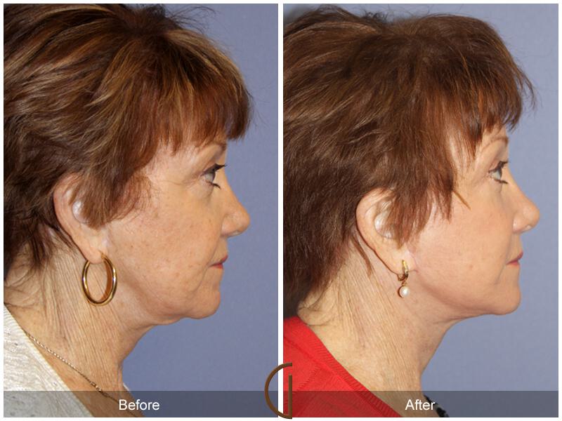 Facelift Revision Before & After Photo