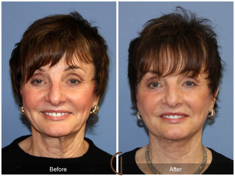 Facelift Revision Before & After Photo