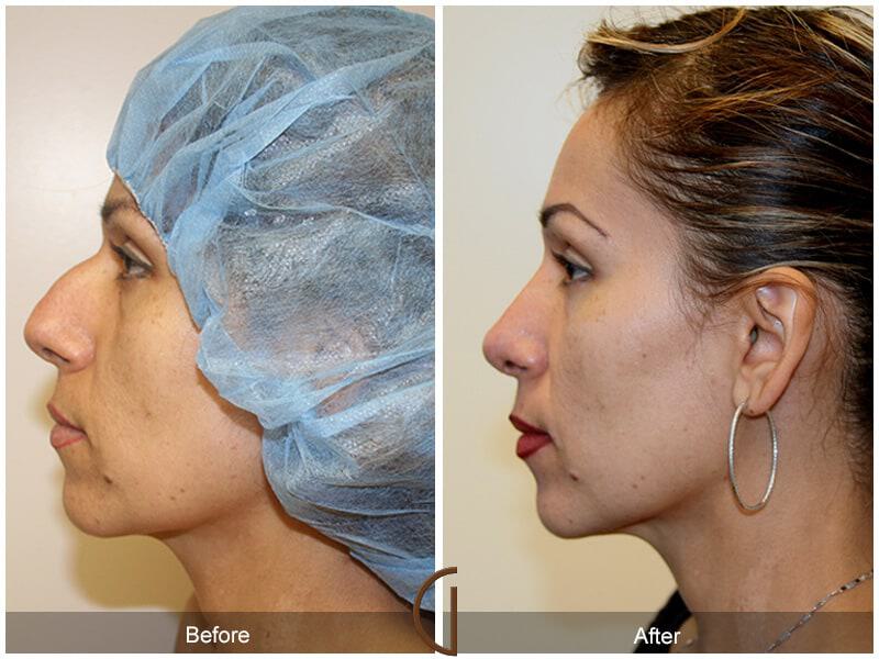 Ethnic Rhinoplasty Before & After Photo