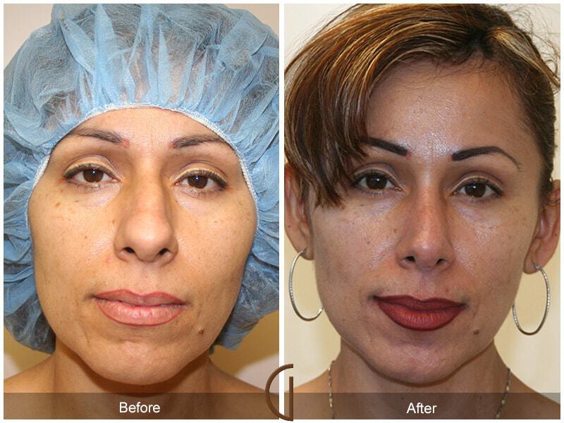 Ethnic Rhinoplasty Before & After Photo