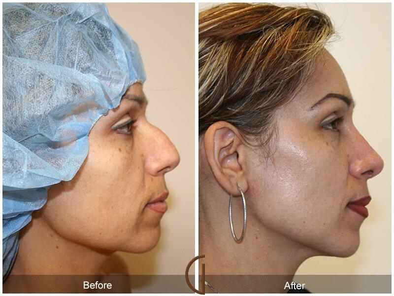 Ethnic Rhinoplasty Before & After Photo