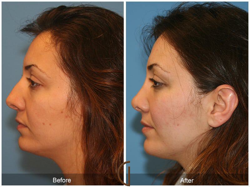 Ethnic Rhinoplasty Before & After Photo