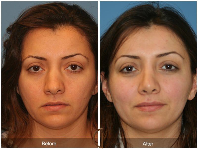 Ethnic Rhinoplasty Before & After Photo