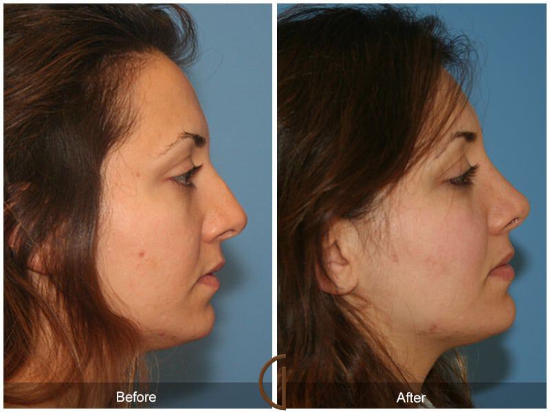 Ethnic Rhinoplasty Before & After Photo