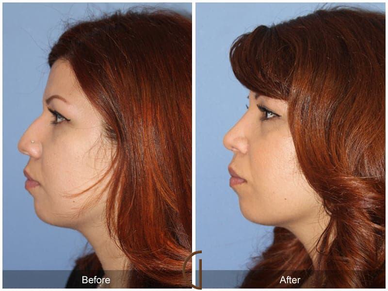 Ethnic Rhinoplasty Before & After Photo