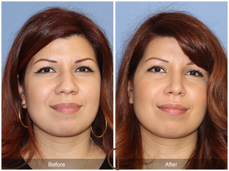 Ethnic Rhinoplasty Before & After Photo